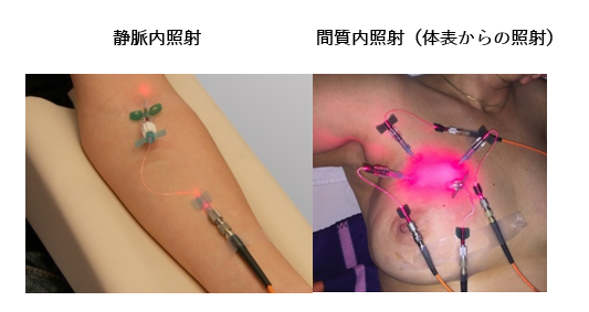 静脈内照射・間質内照射